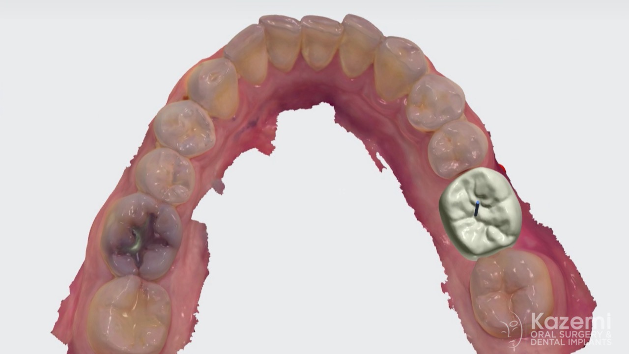 dental-implant-molar-tooth-extraction-bone-loss-digital-dentistry-kazemi-oral-surgery-giannini-gray2