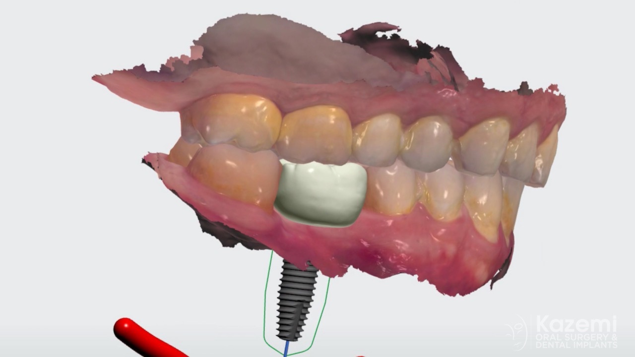 dental-implant-molar-tooth-extraction-bone-loss-digital-dentistry-kazemi-oral-surgery-giannini-gray3