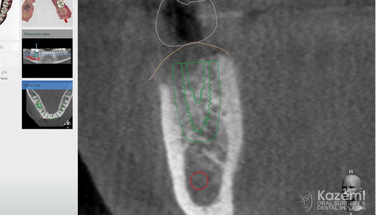 dental-implant-molar-tooth-extraction-bone-loss-digital-dentistry-kazemi-oral-surgery-giannini-gray4
