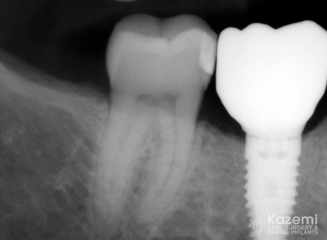 dental-implant-molar-tooth-extraction-bone-loss-digital-dentistry-kazemi-oral-surgery-giannini-gray6
