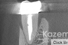 dental-implant-molar-tooth-extraction-bone-loss-digital-dentistry-kazemi-oral-surgery-giannini-gray1