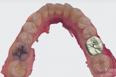 dental-implant-molar-tooth-extraction-bone-loss-digital-dentistry-kazemi-oral-surgery-giannini-gray2