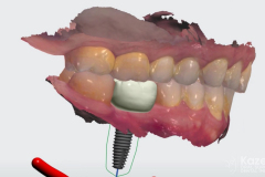 dental-implant-molar-tooth-extraction-bone-loss-digital-dentistry-kazemi-oral-surgery-giannini-gray3