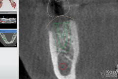 dental-implant-molar-tooth-extraction-bone-loss-digital-dentistry-kazemi-oral-surgery-giannini-gray4