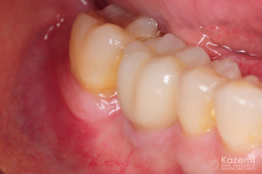 dental-implant-molar-tooth-extraction-bone-loss-digital-dentistry-kazemi-oral-surgery-giannini-gray5
