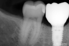dental-implant-molar-tooth-extraction-bone-loss-digital-dentistry-kazemi-oral-surgery-giannini-gray6