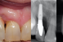 dental-implant-removal-peri-implantitis-infection-reverse-torque-no-bone-removal-kazemi-oral-surgery-1