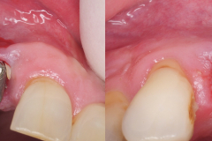dental-implant-removal-peri-implantitis-infection-reverse-torque-no-bone-removal-kazemi-oral-surgery-2