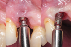 dental-implant-removal-peri-implantitis-infection-reverse-torque-no-bone-removal-kazemi-oral-surgery-3
