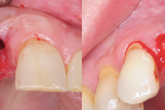 dental-implant-removal-peri-implantitis-infection-reverse-torque-no-bone-removal-kazemi-oral-surgery-4-