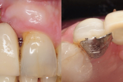 dental-implant-removal-peri-implantitis-infection-reverse-torque-no-bone-removal-kazemi-oral-surgery-5