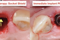 socket-shield-partial-extraction-therapy-PET-kazemi-oral-surgery-2