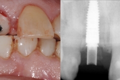 socket-shield-partial-extraction-therapy-PET-kazemi-oral-surgery-3
