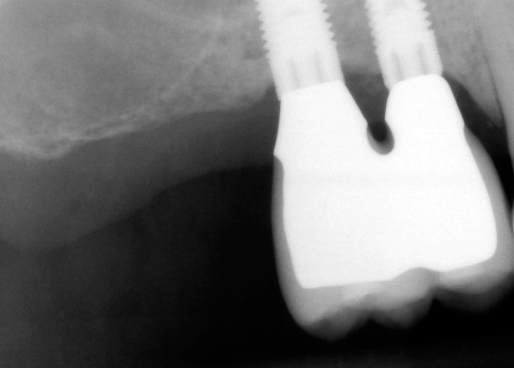 11.-sinus-lift-bone-graft-dental-implants-kazemi-oral-surgery