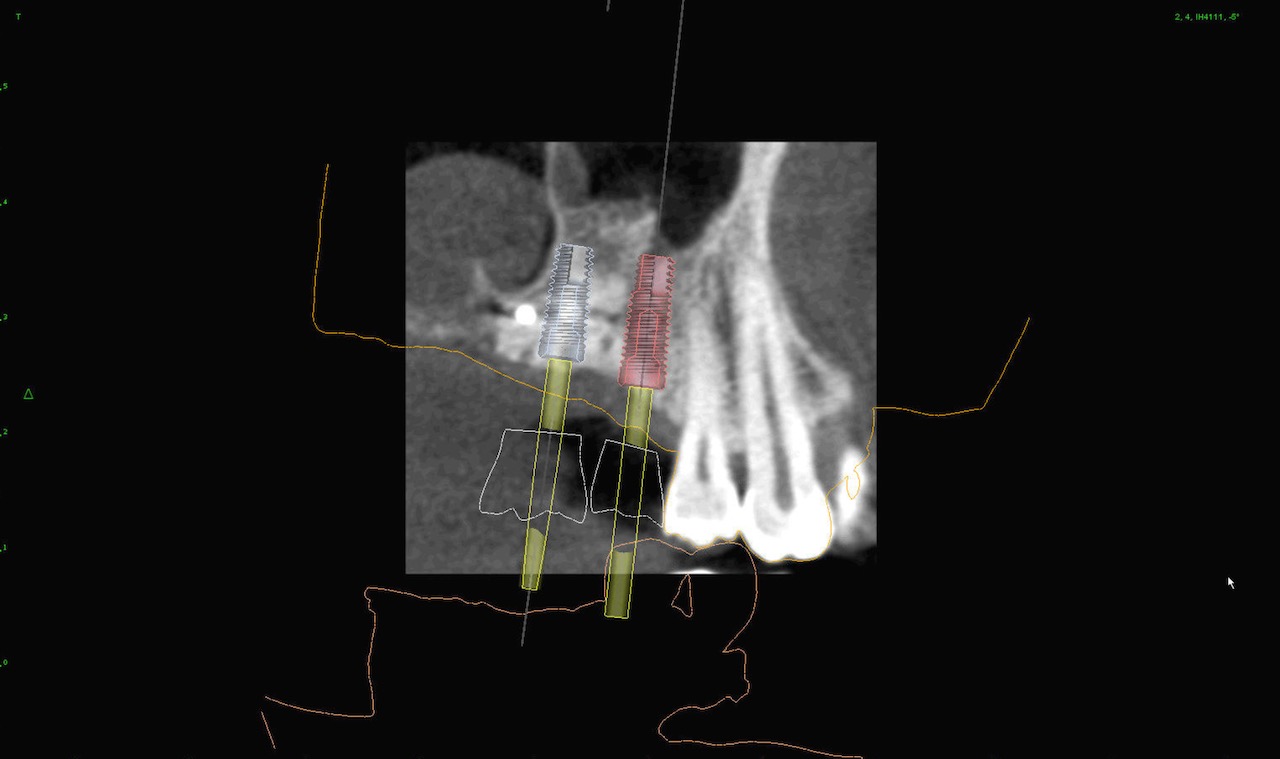 7.-sinus-lift-bone-graft-dental-implants-digital-kazemi-oral-surgery