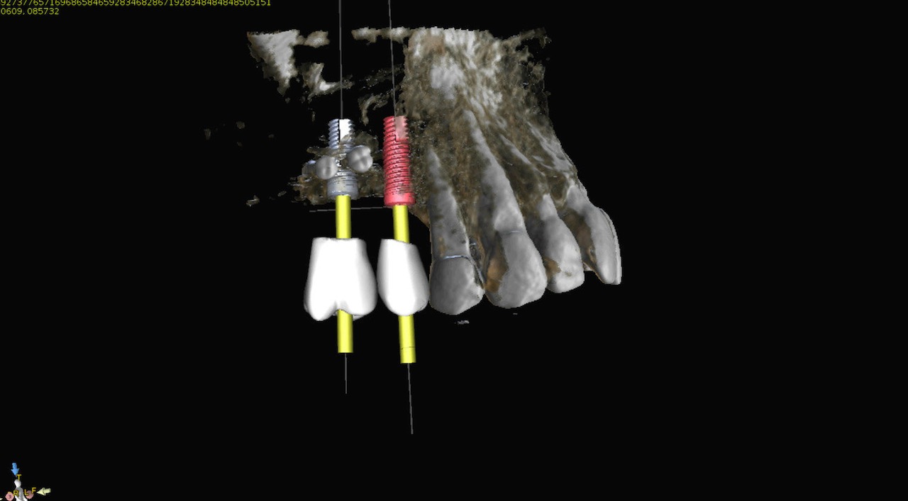8.-sinus-lift-bone-graft-dental-implants-digital-kazemi-oral-surgery