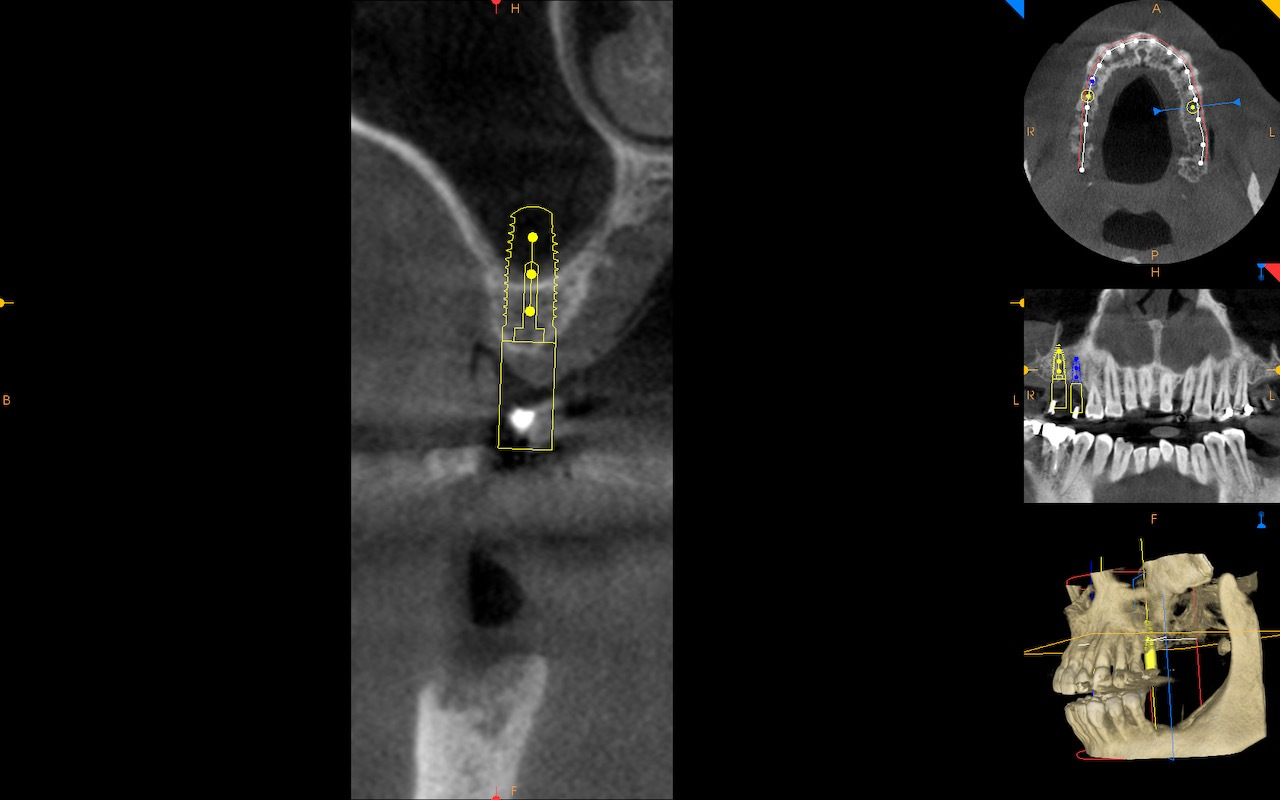 2.-sinus-lift-bone-graft-dental-implants-kazemi-oral-surgery