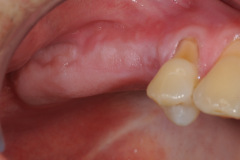 1.-sinus-lift-bone-graft-dental-implants-kazemi-oral-surgery
