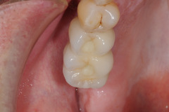10.-sinus-lift-bone-graft-dental-implants-kazemi-oral-surgery