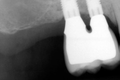 11.-sinus-lift-bone-graft-dental-implants-kazemi-oral-surgery