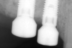 12.-sinus-lift-bone-graft-dental-implants-kazemi-oral-surgery