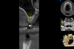 2.-sinus-lift-bone-graft-dental-implants-kazemi-oral-surgery
