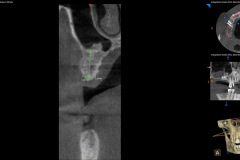 3.-sinus-lift-bone-graft-dental-implants-kazemi-oral-surgery