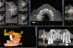 4.-sinus-lift-bone-graft-dental-implants-digital-work-up-kazemi-oral-surgery
