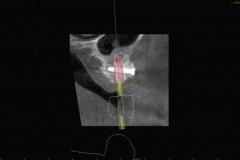 5.-sinus-lift-bone-graft-dental-implants-digital-kazemi-oral-surgery