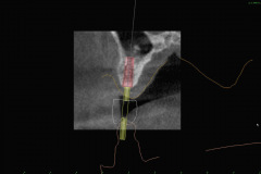 6.-sinus-lift-bone-graft-dental-implants-digital-kazemi-oral-surgery