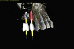 8.-sinus-lift-bone-graft-dental-implants-digital-kazemi-oral-surgery