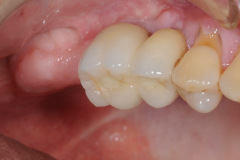 9.-sinus-lift-bone-graft-dental-implants-kazemi-oral-surgery