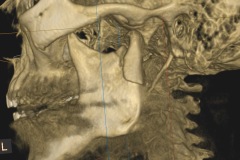 displaced-subcondylar-jaw-fracture-of-mandible-kazemi-oral-surgery-1