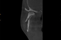 displaced-subcondylar-jaw-fracture-of-mandible-kazemi-oral-surgery-2