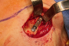 open-reduction-internal-fixation-of-subcondylar-fracture-of-mandible-kazemi-oral-surgery-1