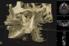 open-reduction-internal-fixation-of-subcondylar-fracture-of-mandible-kazemi-oral-surgery-2