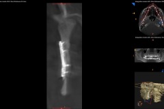 open-reduction-internal-fixation-of-subcondylar-fracture-of-mandible-kazemi-oral-surgery-3