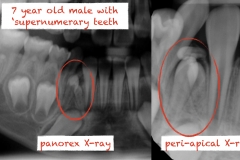 2.-super-numarary-teeth-odontoma-extraction-kazemi-oral-surgery
