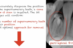 3.-super-numarary-teeth-odontoma-extraction-kazemi-oral-surgery