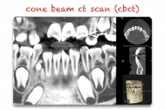 4.-super-numarary-teeth-odontoma-extraction-kazemi-oral-surgery