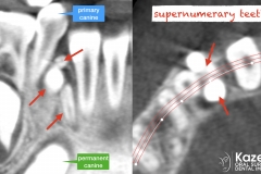 5.-super-numarary-teeth-odontoma-extraction-kazemi-oral-surgery