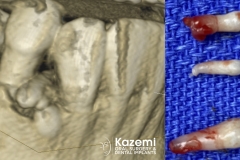 8.-super-numarary-teeth-odontoma-extraction-kazemi-oral-surgery