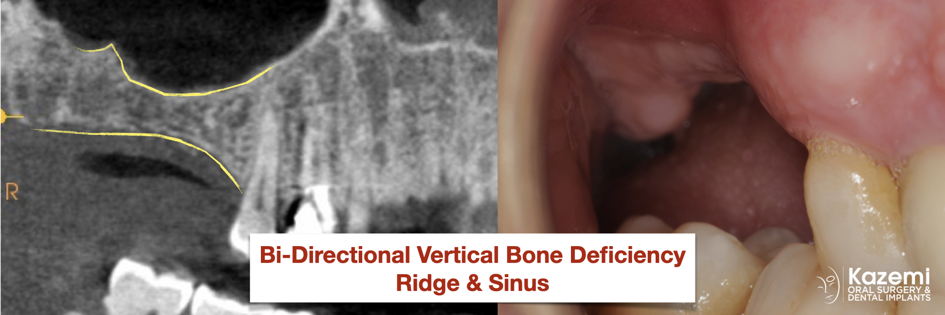 Sinus-lift-bone-graft-Ridge-bone-graft-vertical-deficiency-for-dental-implants-kazemi-oral-surgery-bethesda-MD.001