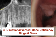 Sinus-lift-bone-graft-Ridge-bone-graft-vertical-deficiency-for-dental-implants-kazemi-oral-surgery-bethesda-MD.001