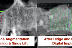 Sinus-lift-bone-graft-Ridge-bone-graft-vertical-deficiency-for-dental-implants-kazemi-oral-surgery-bethesda-MD.002