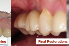 Sinus-lift-bone-graft-Ridge-bone-graft-vertical-deficiency-for-dental-implants-kazemi-oral-surgery-bethesda-MD.003