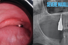 zygomatic-pterygoid-dental-implants-severe-bone-loss-kazemi-oral-surgery-1