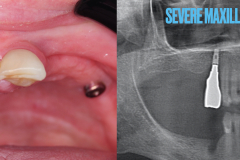 zygomatic-pterygoid-dental-implants-severe-bone-loss-kazemi-oral-surgery-2