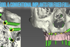 zygomatic-pterygoid-dental-implants-severe-bone-loss-kazemi-oral-surgery-3
