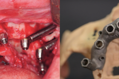 zygomatic-pterygoid-dental-implants-severe-bone-loss-kazemi-oral-surgery-5